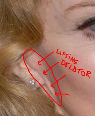 Curso de detección de lifting » liftdelator2.miniatura liftdelator2.jpg